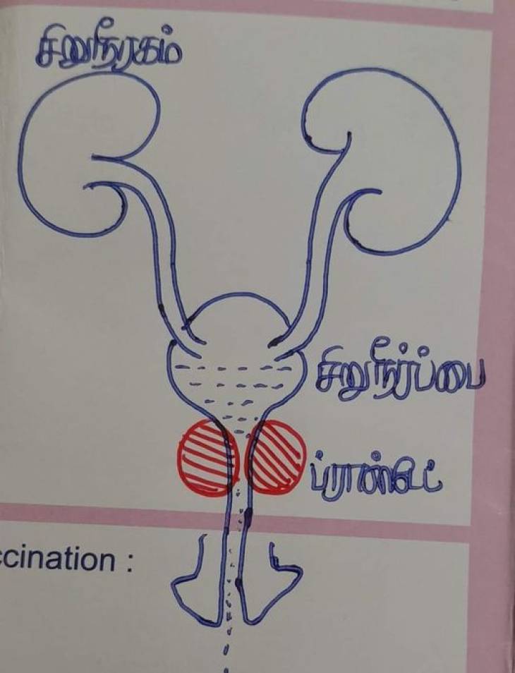 ஆண்களை அச்சுறுத்தும் ப்ராஸ்டேட் சுரப்பி வீக்கமும் - சிறுநீர் கழித்தல் பிரச்சனையும்!